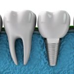 historia-implantes-dentales