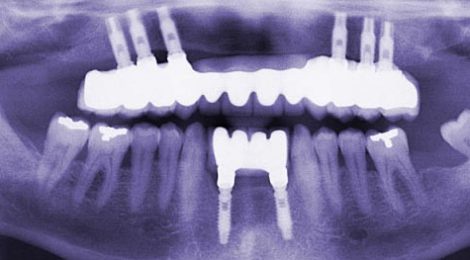 osteointegracion implantes dentales