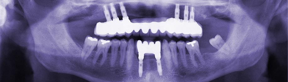 osteointegracion implantes dentales