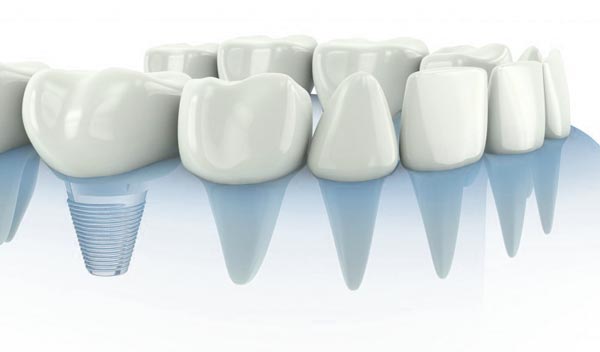 características-implantes-dentales