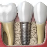 implantes dentales recubrimiento