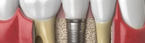 implantes dentales recubrimiento