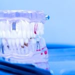 implantología dental 4d