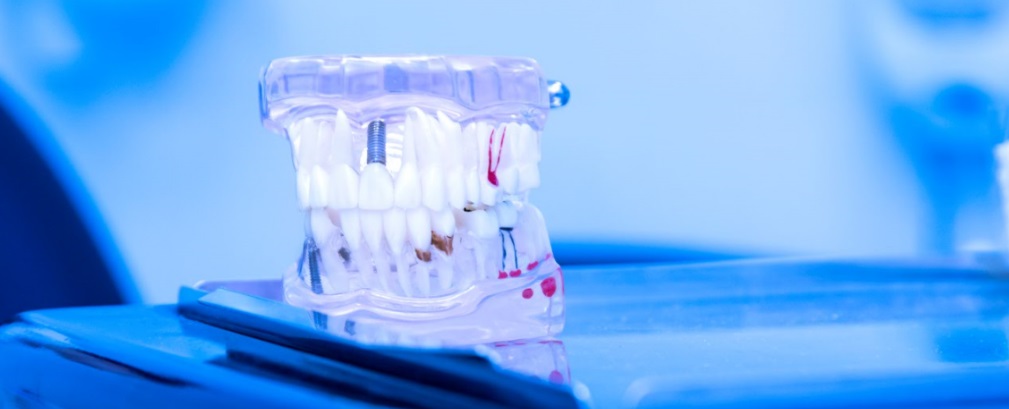 implantología dental 4d