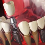 tratamientos implantes dentales