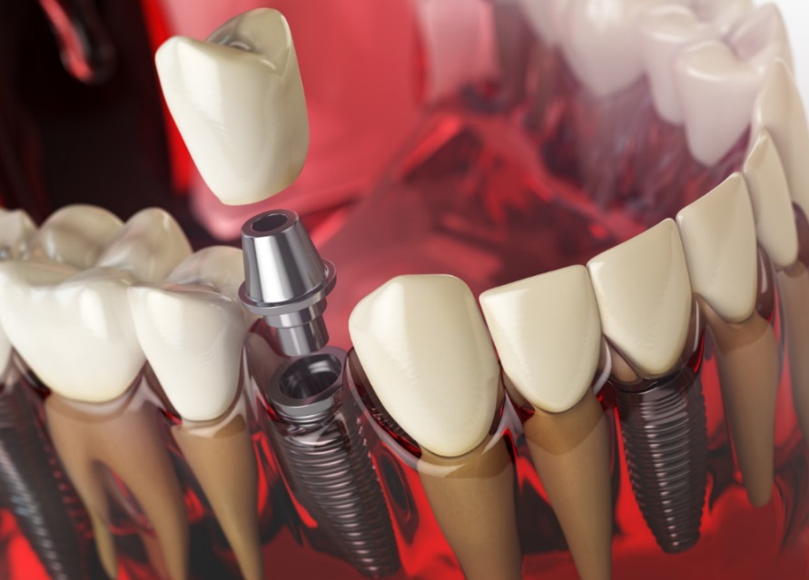 tratamientos implantes dentales